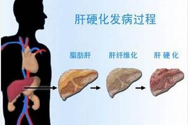 肝硬化晚期症状有哪些 解析四大症状说明
